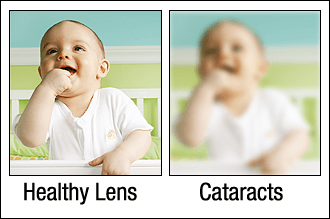 Cataract before and after