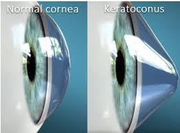 diagram of an eye with keratoconus
