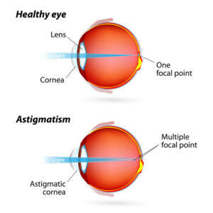 diagram of a healthy eye and an eye with an astigmatism 