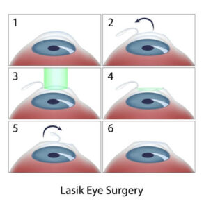 lasik eye surgery diagram 